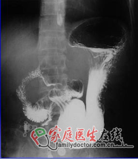 CT檢查、X線檢查等常用醫學影像學檢查方法的價值和局限