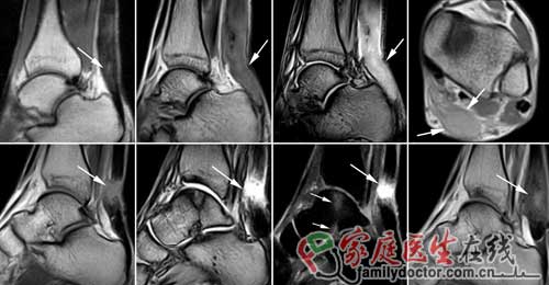 劉翔跟腱手術成功 專家：確診及治療有賴磁共振