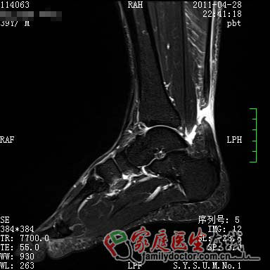 劉翔跟腱手術成功 專家：確診及治療有賴磁共振